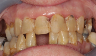 Close up of smile with missing and damaged teeth